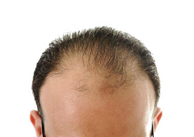 Haarausfall an der Vorderseite des Kopfes